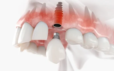 Single tooth dental implants in Naples, FL