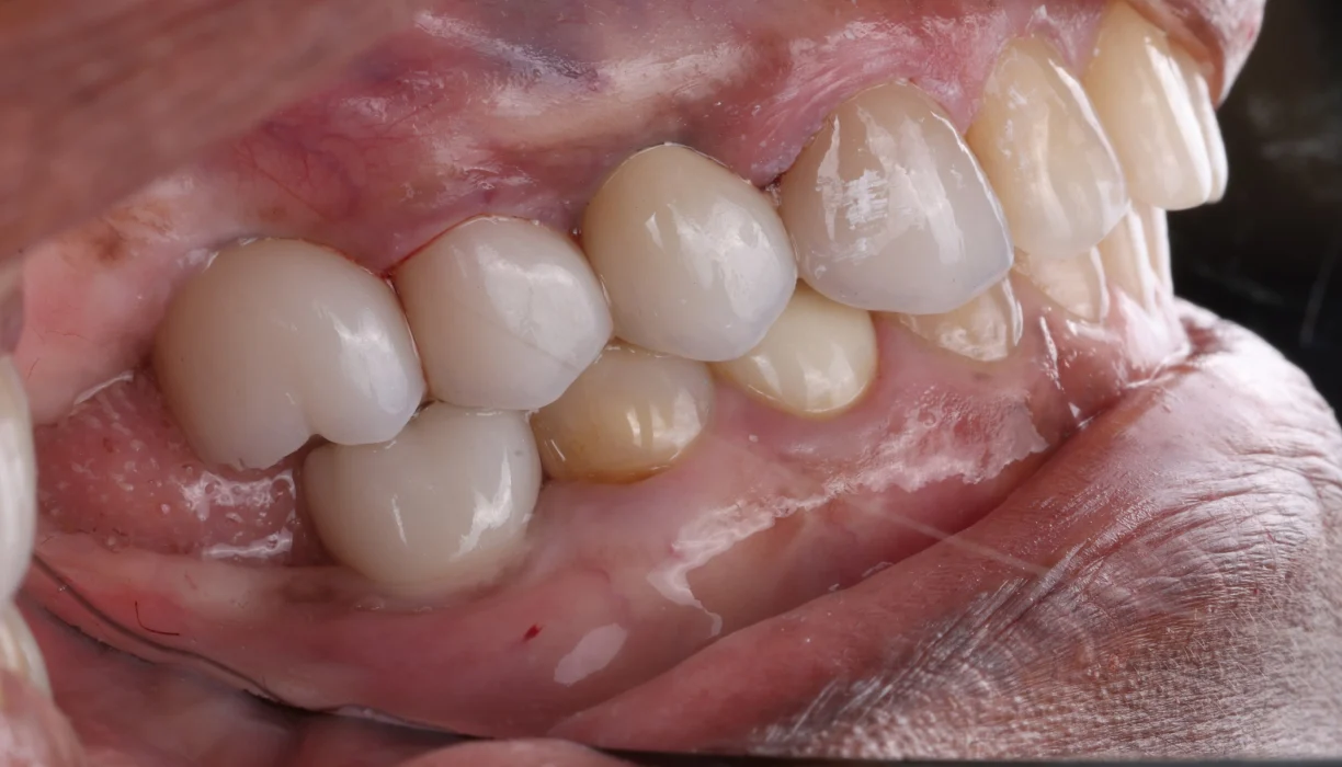Single tooth dental implant case 2, after treatment: the gap filled with a replacement tooth matching the neighboring teeth