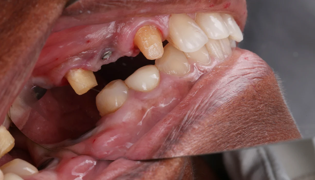 Single tooth dental implant case 2, before treatment: a gap where a tooth is missing beside a worn tooth