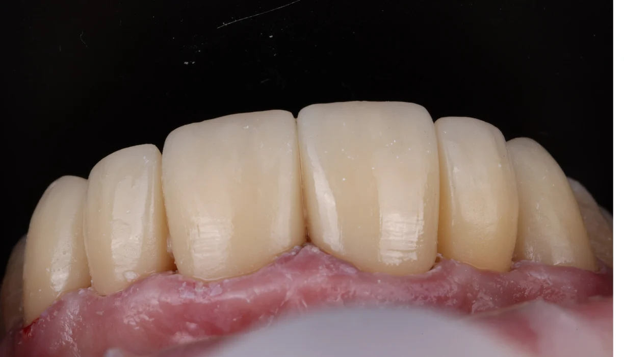 Single tooth dental implant case 3, after treatment: a replacement tooth filling the gap in the front teeth