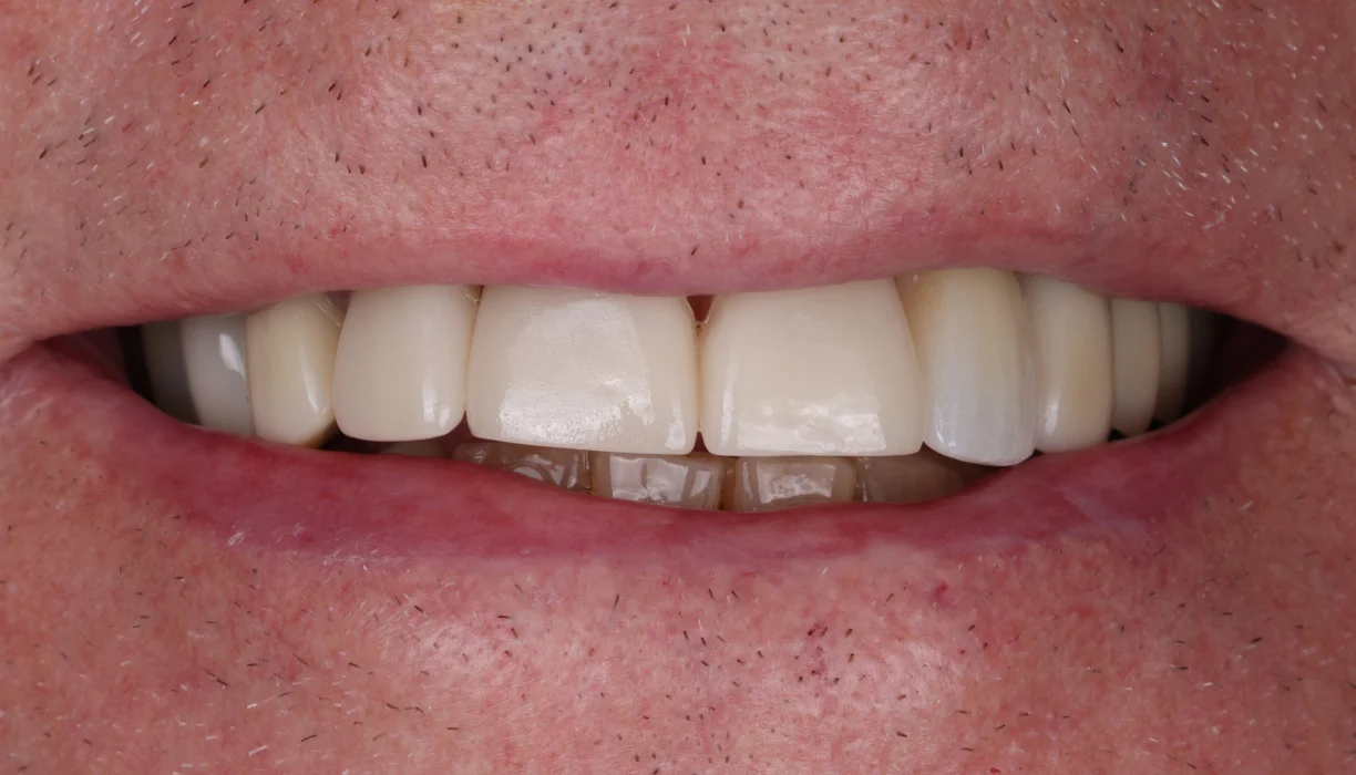 Single tooth dental implant case 4, after treatment: a replacement tooth filling the gap in a natural-looking smile