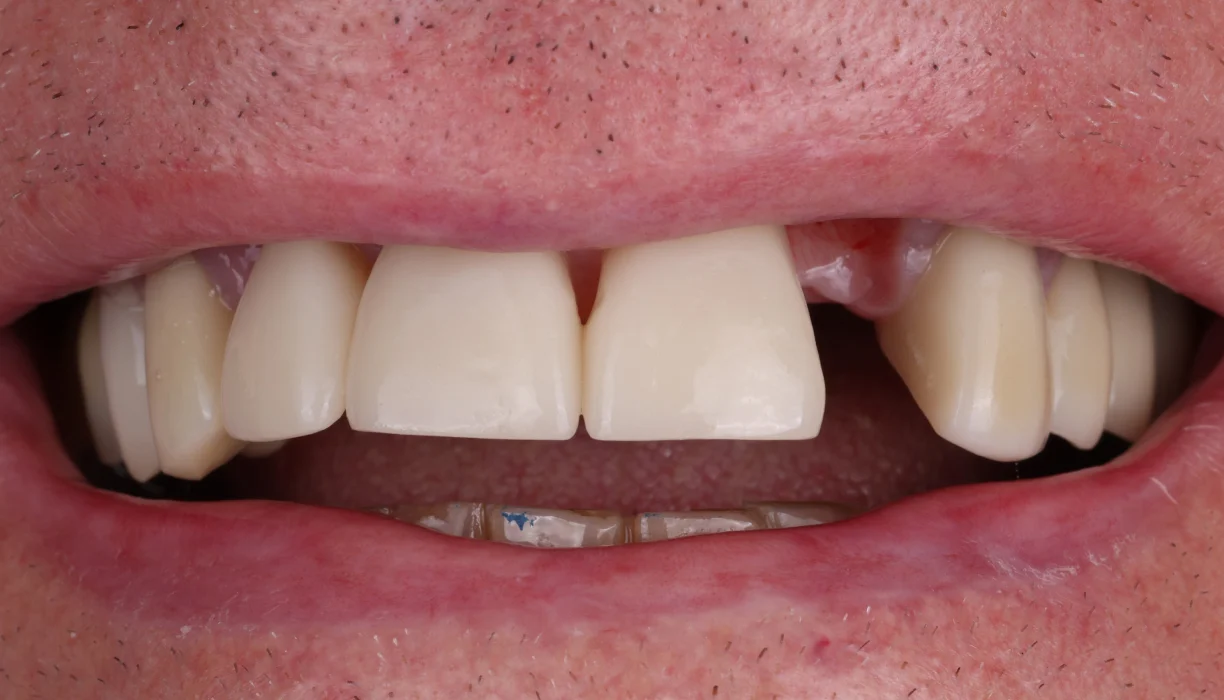 Single tooth dental implant case 4, before treatment: a gap between the front teeth where a tooth is missing