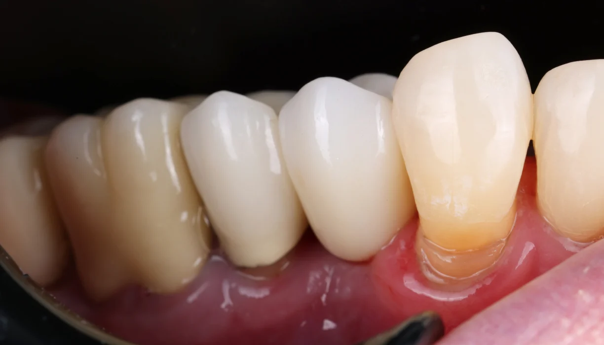 Single tooth dental implant case 5, after treatment: a replacement tooth filling the gap on the lower arch