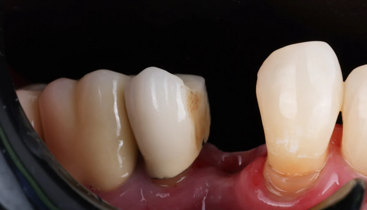 Single tooth dental implant case 5, before treatment: a gap on the lower arch where a tooth is missing