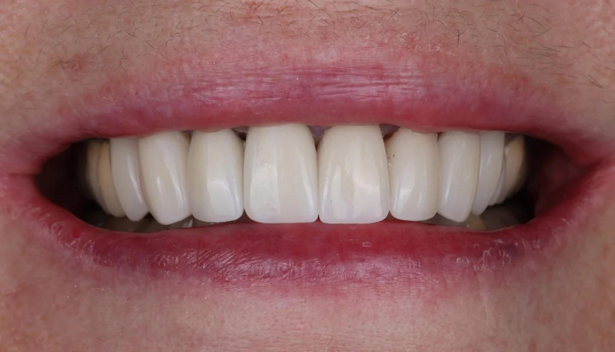 Smile makeover case 1, after treatment: longer, bright white teeth in a full smile