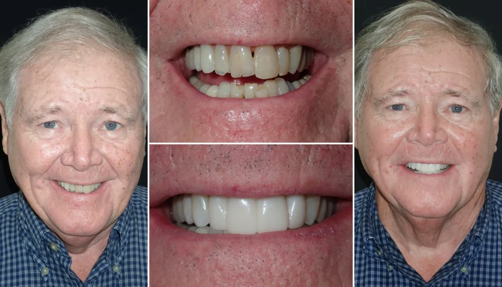 Smile makeover case 2, before and after: older man with white hair, teeth restored to a brighter, more even smile