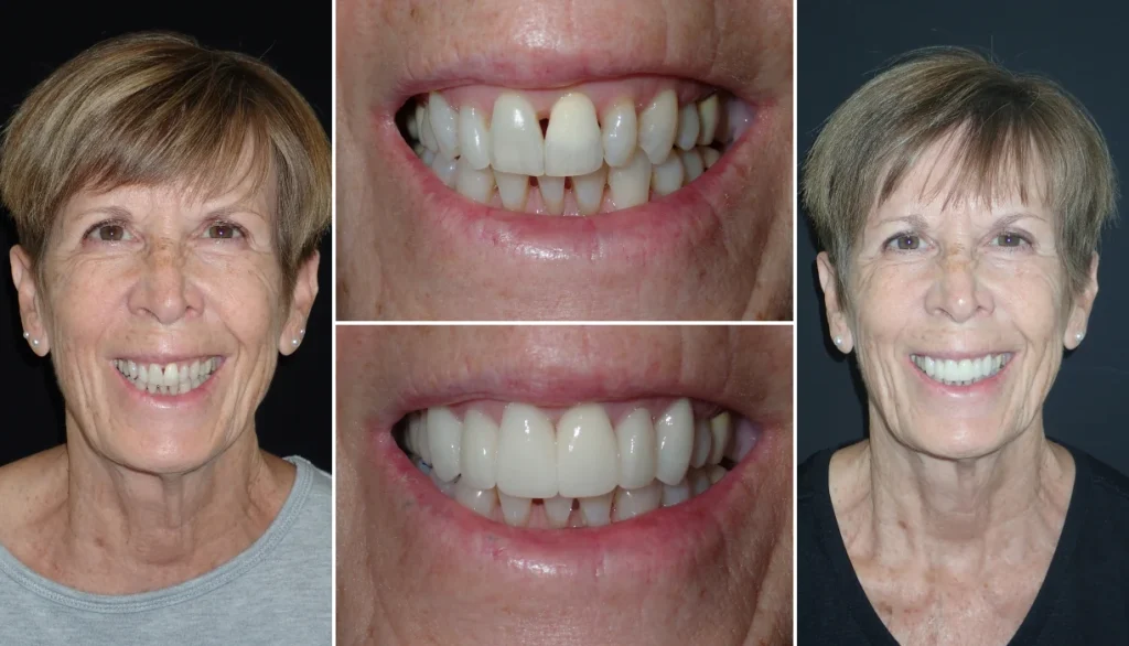 Smile makeover case 4, before and after: older woman with short hair, smile changed to brighter, more even teeth