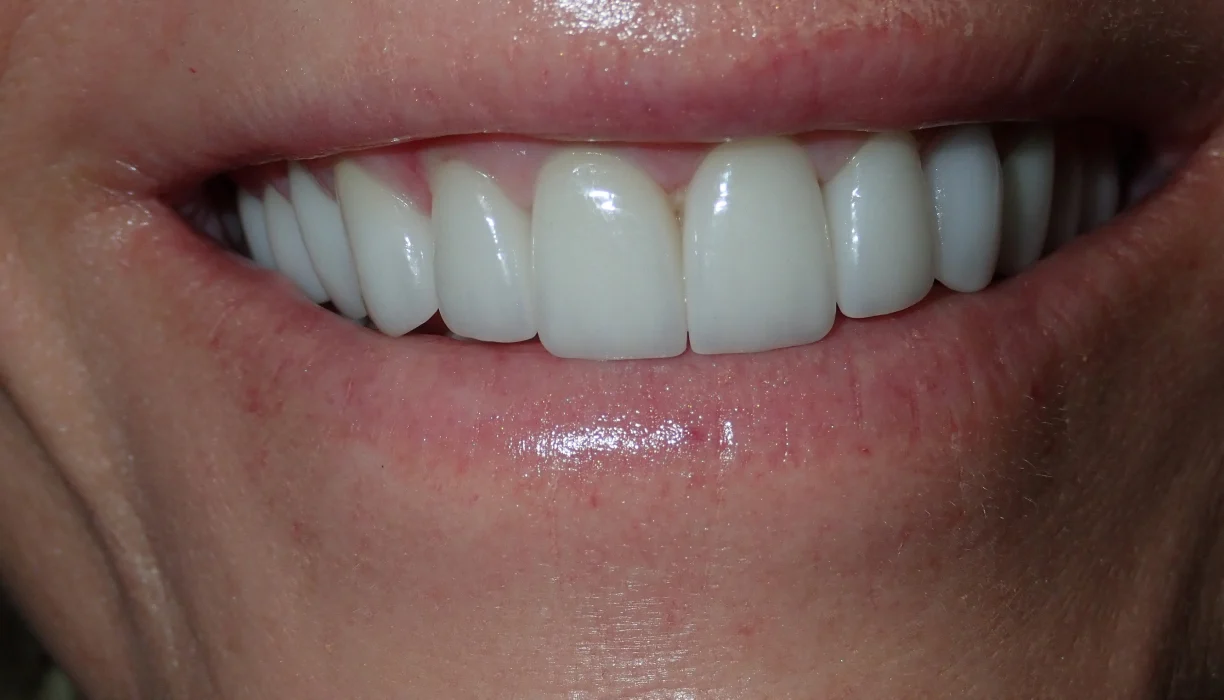 Smile makeover case 5, after treatment: smooth, evenly shaped upper teeth in a wide smile