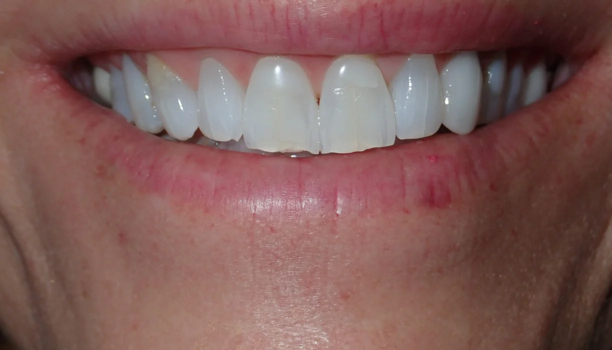 Smile makeover case 5, before treatment: upper teeth with slight crowding and uneven edges