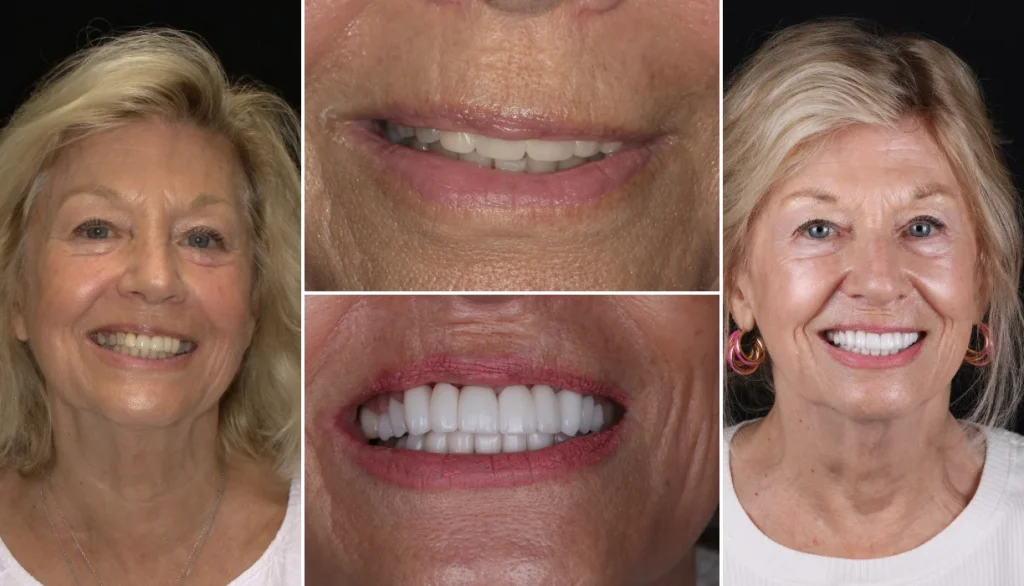 Smile makeover case 6, before and after: woman with blonde hair, smile changed to brighter, even teeth