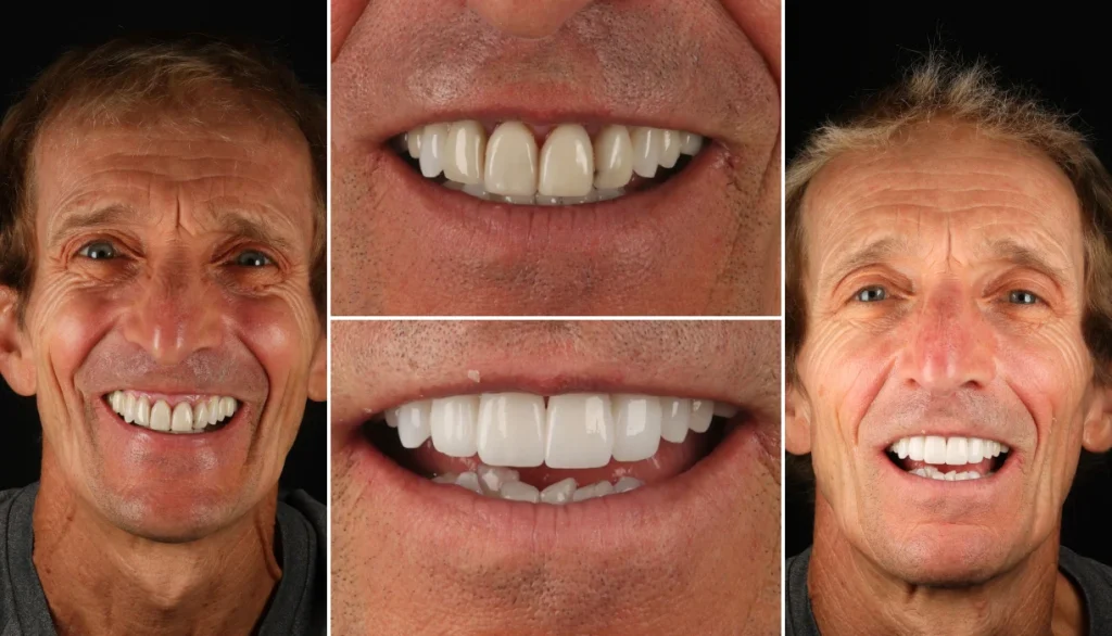 Smile makeover case 7, before and after: man with dark hair, teeth with gaps replaced by a full, even smile