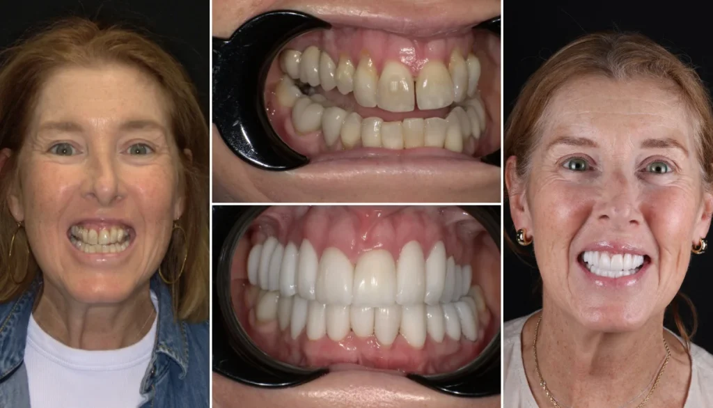 Smile makeover case 8, before and after: woman with light brown hair, worn teeth changed to a full, bright smile