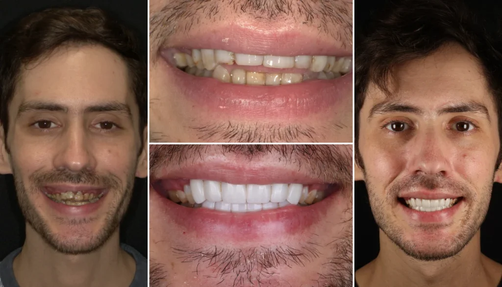 Smile makeover case 9, before and after: young man with dark hair and stubble, smile changed to straighter, brighter teeth