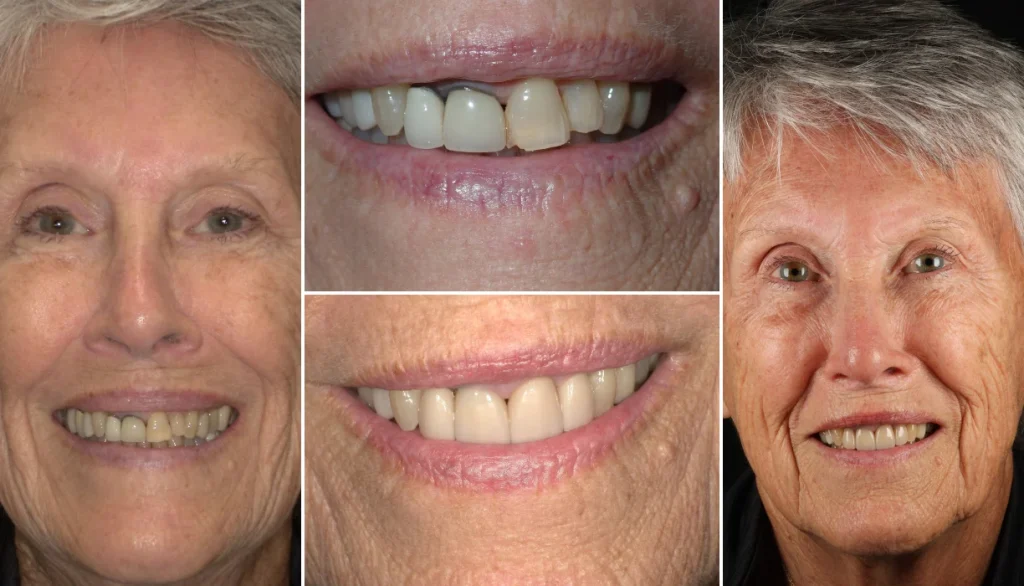 Smile makeover case 10, before and after: older woman with white hair, yellowed teeth changed to a brighter smile