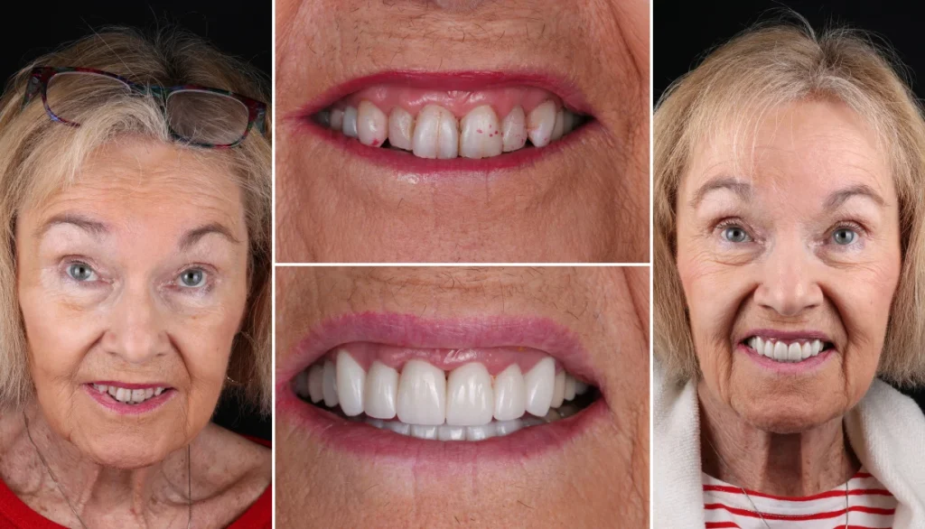 Smile makeover case 11, before and after: woman with blonde hair, smile changed to brighter, more even teeth