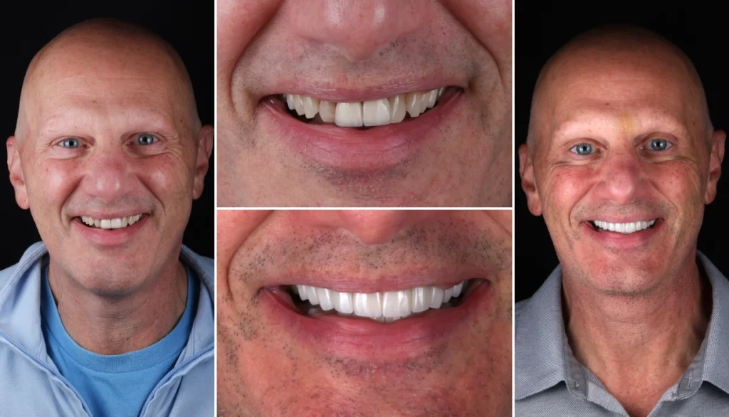 Smile makeover case 13, before and after: smiling bald man, teeth changed to a brighter, more even smile