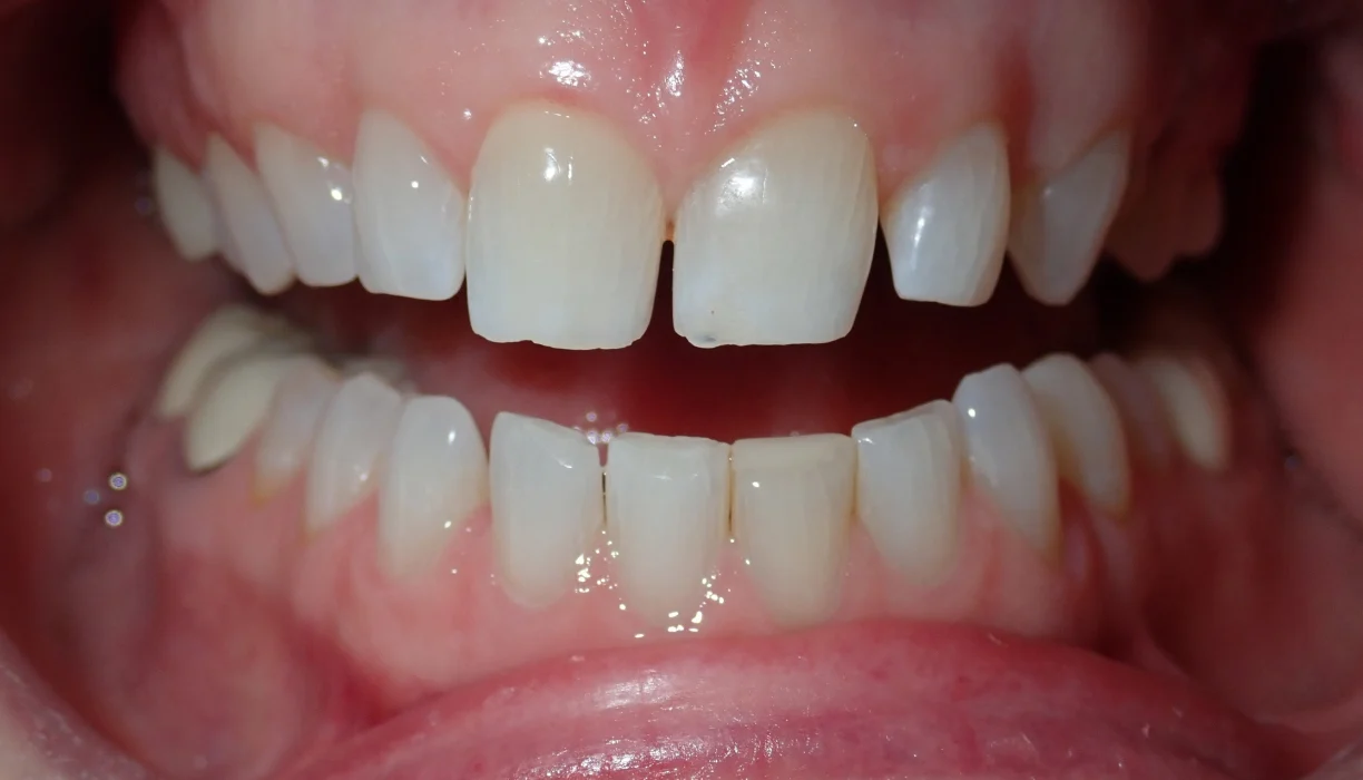 Smile makeover case 14, before treatment: upper front teeth with a gap and uneven edges