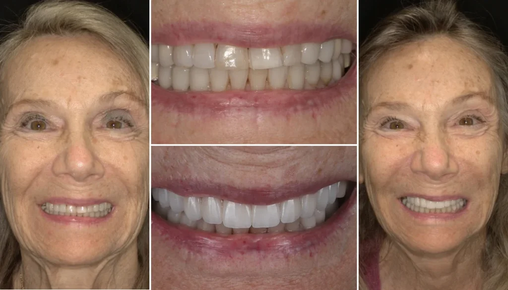 Smile makeover case 16, before and after: older woman with light brown hair, smile changed to brighter, more even teeth