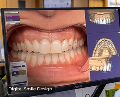 Digital smile design for a smile trial