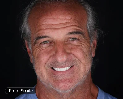 Final smile after a smile trial